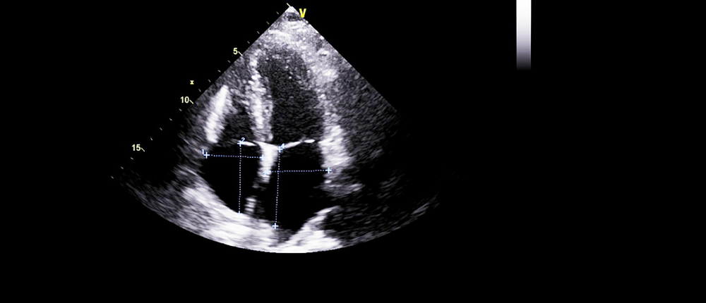 Echo image of heart