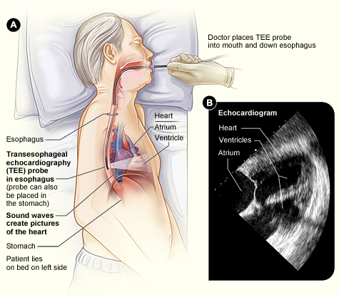 Transesophageal Echo